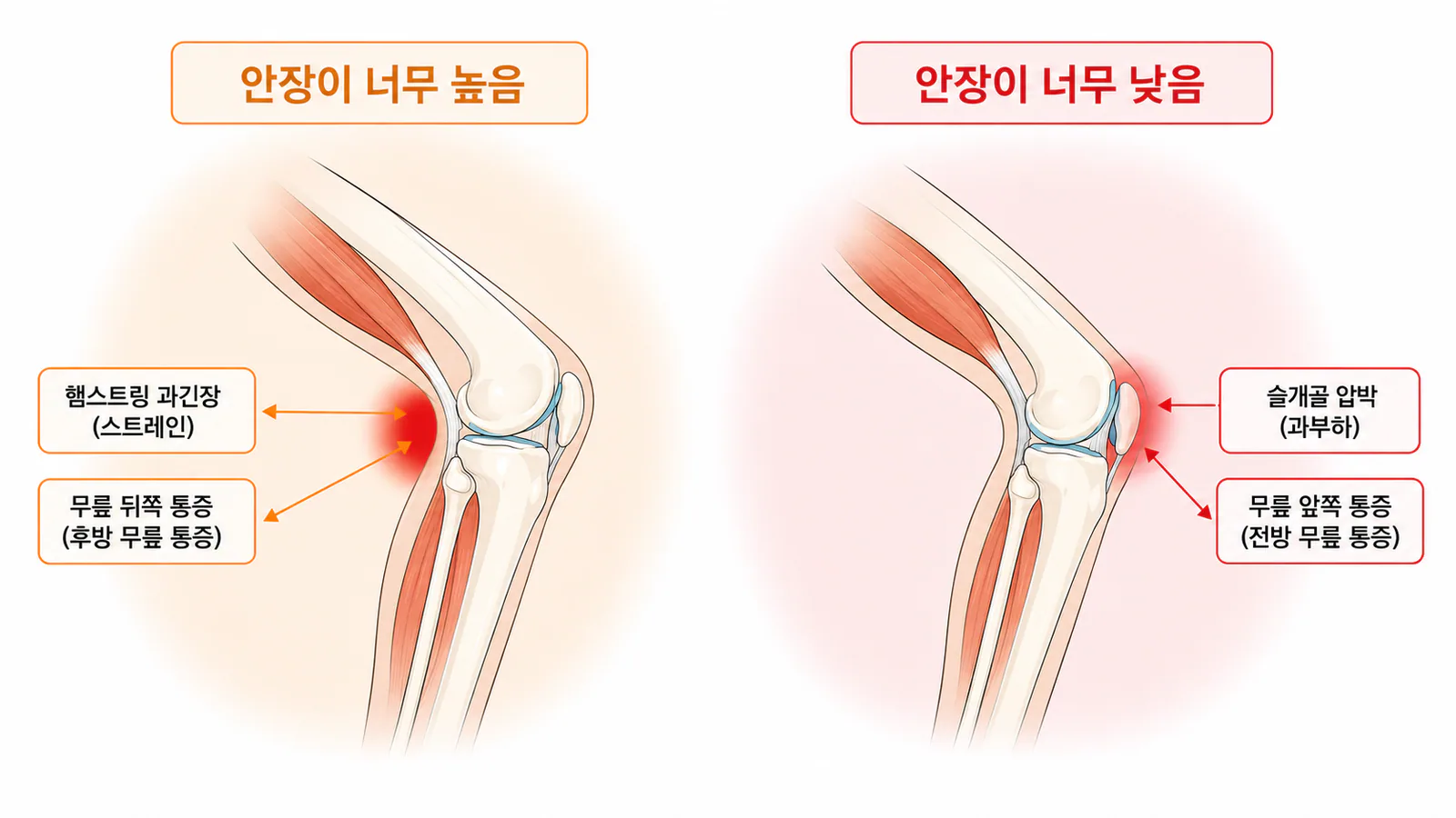 안장 너무 높음/낮음 — 무릎 통증 부위 비교 (햄스트링 과긴장 vs 슬개골 압박)